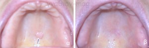 Εικόνα 4. α. Ίνωμα της υπερώας από χρόνιο ερεθισμό ολικής οδοντοστοιχίας (βέλος), β. Μετά την χειρουργική του αφαίρεση.